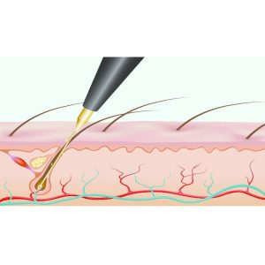 دستگاه الکترولیز ساده استارمکس بیوتی