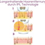 دستگاه رفع موی زائد بدن مدل IPL-8800 بیورر - Image 3
